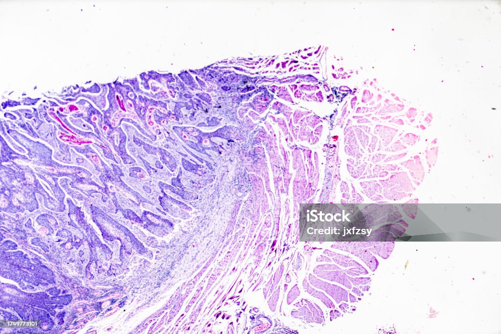 Squamous Cell Microscope Squamous Cell Carcinoma Under Microscopy Stock Photo - Download Image ...