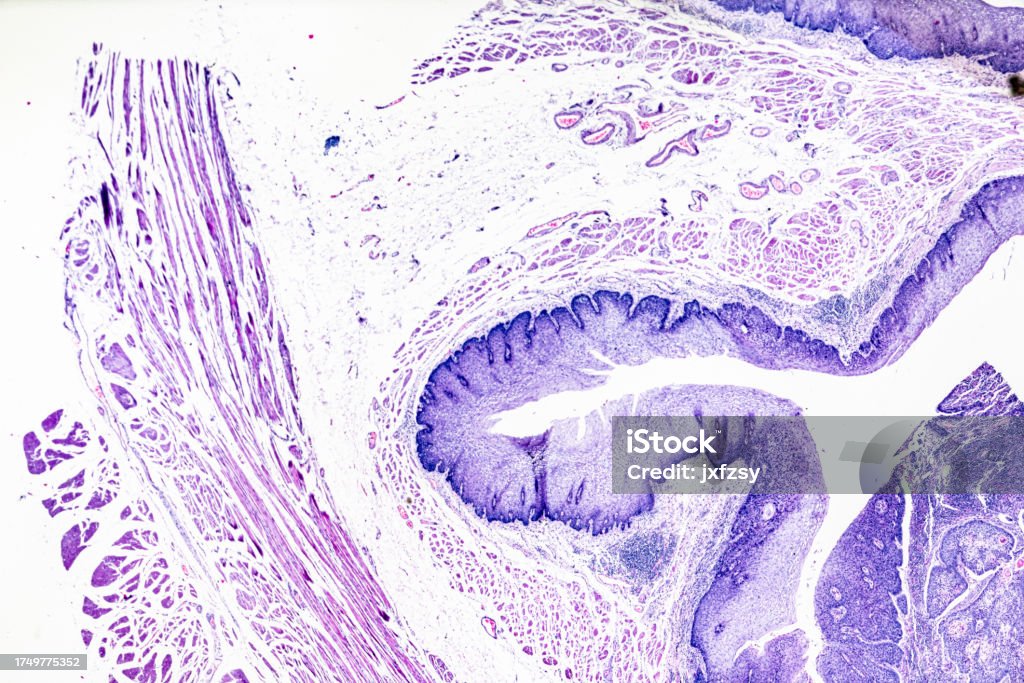 Squamous Cell Microscope Squamous Cell Carcinoma Under Microscopy Stock Photo - Download Image ...