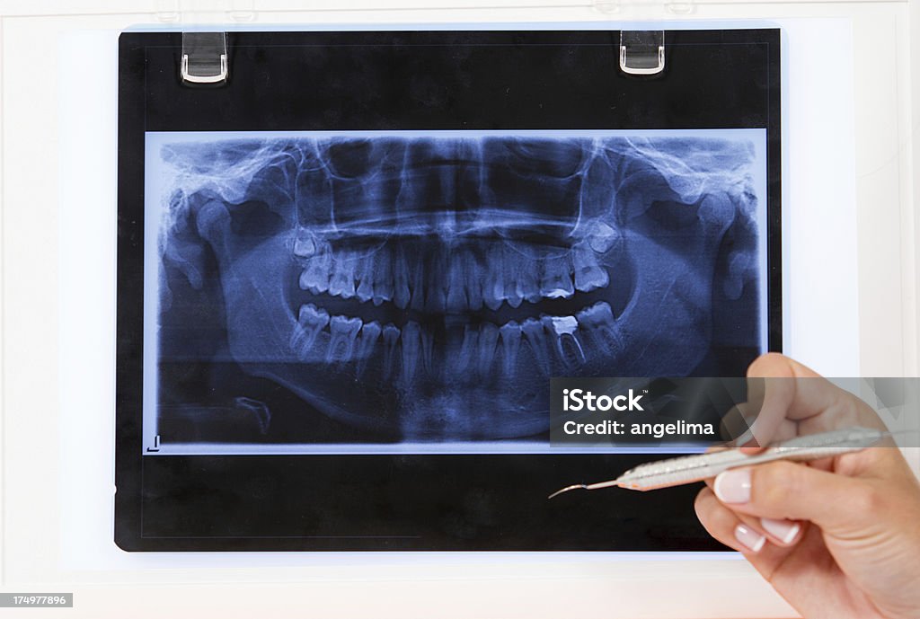 x-ray dentaire - Photo de Abscès libre de droits