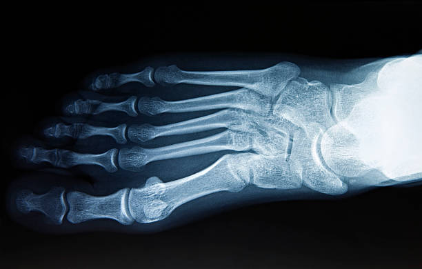 pé de imagem de raios x - bending human foot ankle x ray image - fotografias e filmes do acervo