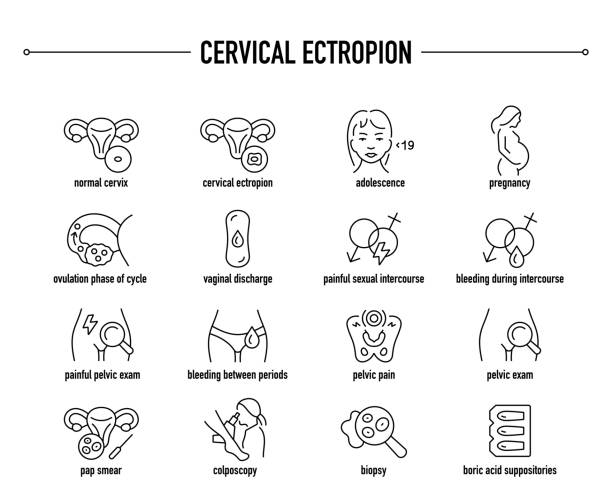 kuvapankkikuvitukset aiheesta kohdunkaulan ektropion oireet, diagnostiset ja hoitovektorikuvakkeet. - gynekologinen tutkimus
