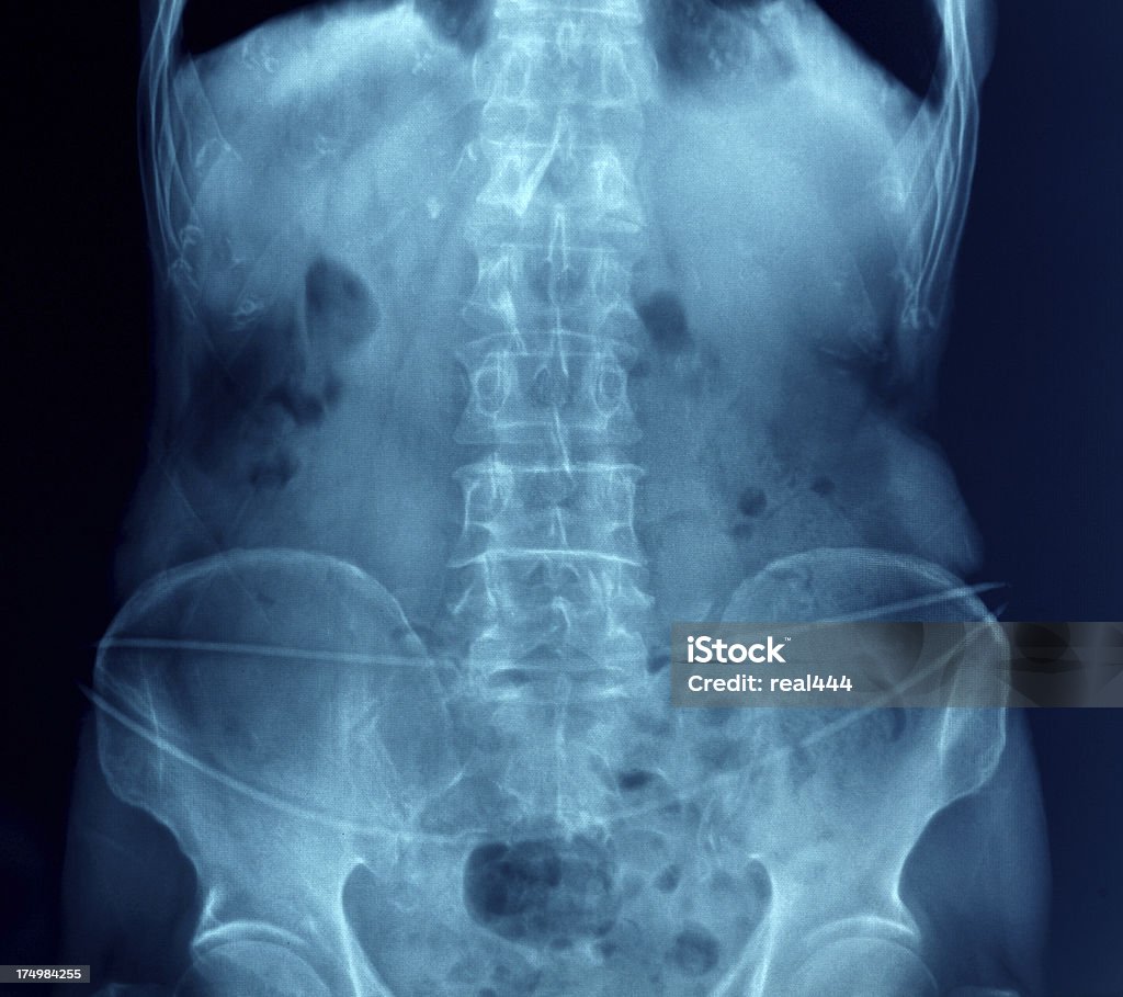 Vertèbre xray - Photo de Imagerie par rayons x libre de droits