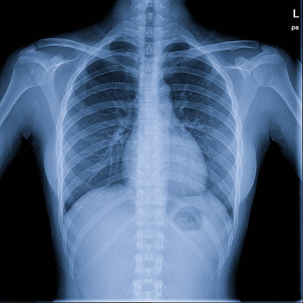 상장형 인간 - human lung x ray image x ray human spine 뉴스 사진 이미지