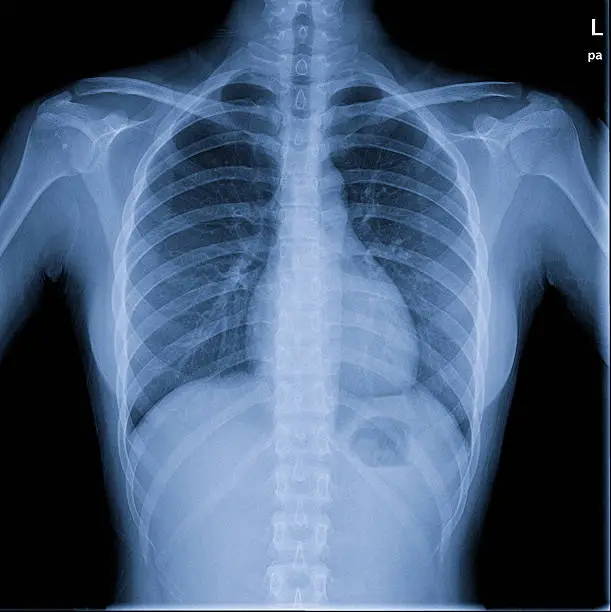 "chest of human,x ray image"