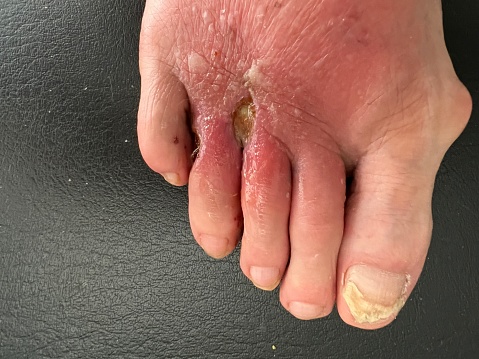 Extender tendon surgery that became infected on a senior mans foot also showing large bunion