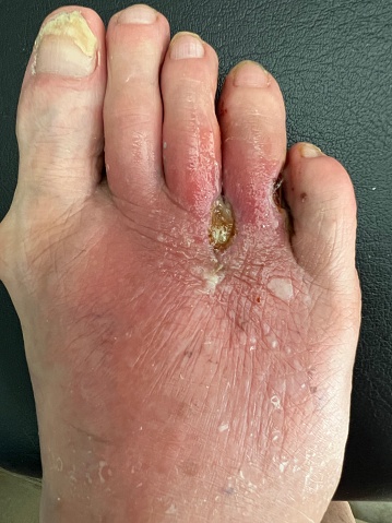 Extender tendon surgery that became infected on a senior mans foot also showing large bunion