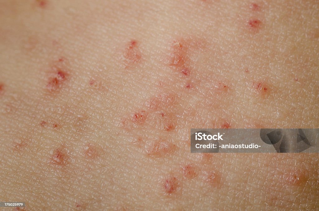 eczema pele - Foto de stock de Eczema royalty-free