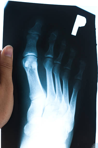 authentique x-ray de malé pied - x ray human knee orthopedic equipment human bone photos et images de collection