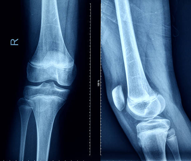 istock Knee X-Ray Bones Human Leg Anatomy 175175460