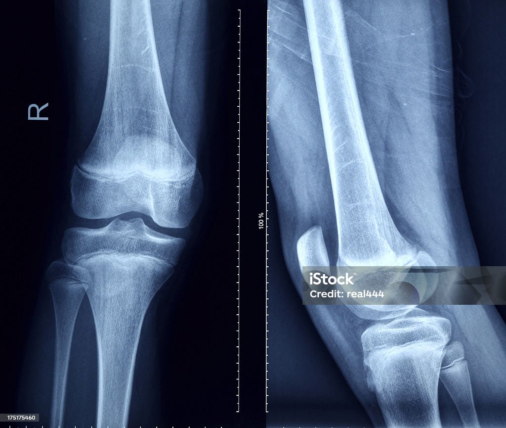 Knee X-Ray Bones Human Leg Anatomy Healthy Lifestyle Stock Photo