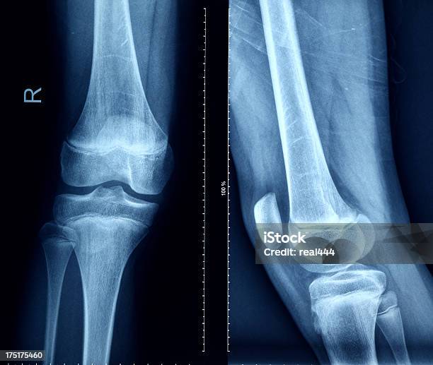 Knee Xray Bones Human Leg Anatomy Stock Photo - Download Image Now - Healthy Lifestyle, Leg Bone, Medical X-ray