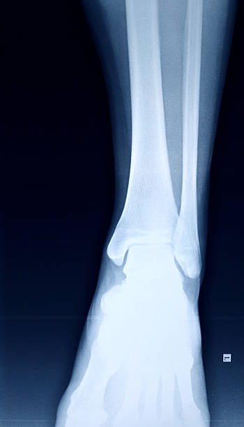 imagem de raios x do pé. - bending human foot ankle x ray image - fotografias e filmes do acervo