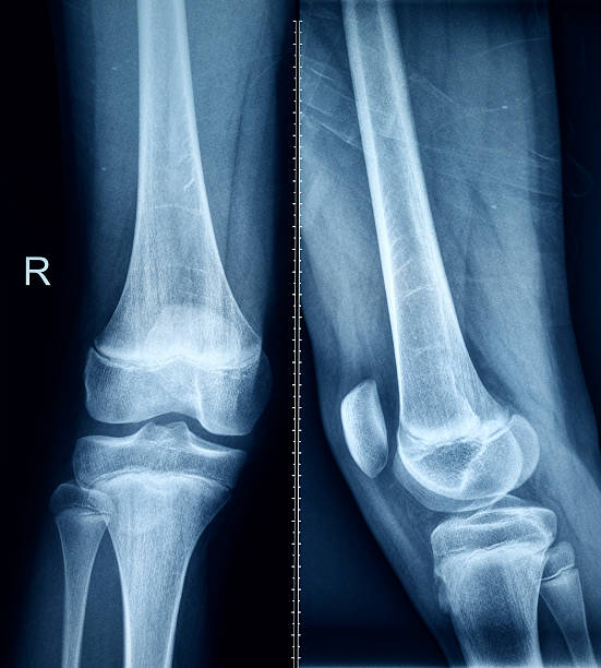 무릎 x-레이 뼈 휴머니즘 신체부위 구조 - cartilage patella human knee medical exam 뉴스 사진 이미지