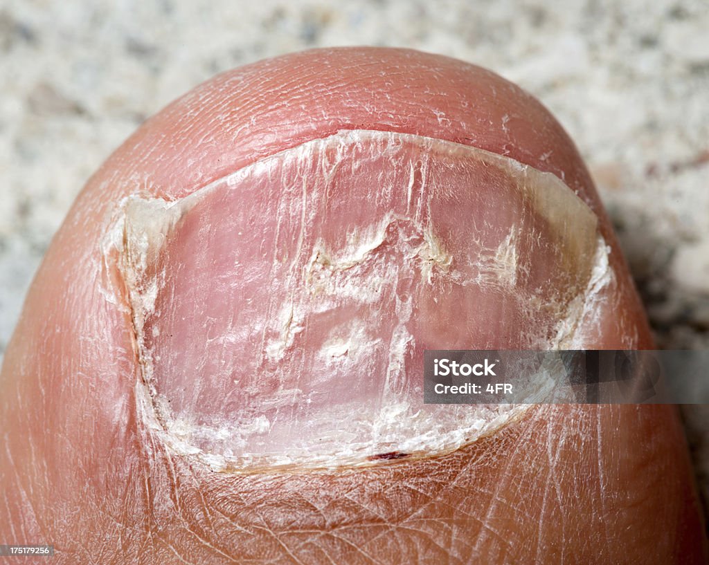 Nail Fungus, Dry rough Toe Foot Macro "Nail Fungus, Dry rough Toe Foot Macro. Nikon D800e. Converted from RAW." Athlete's Foot Stock Photo