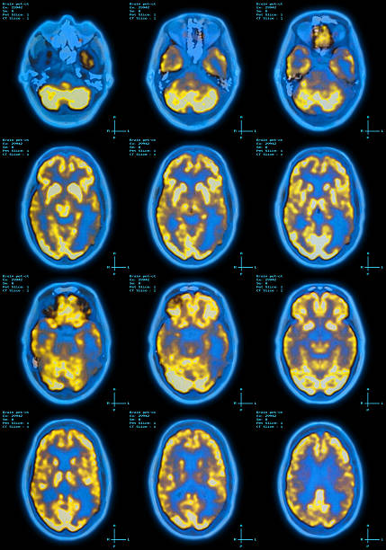 Brain Pet-CT scan  http://cginspiration.com//Istock/V2/WhiteCharacters.jpg pet scan photos stock pictures, royalty-free photos & images