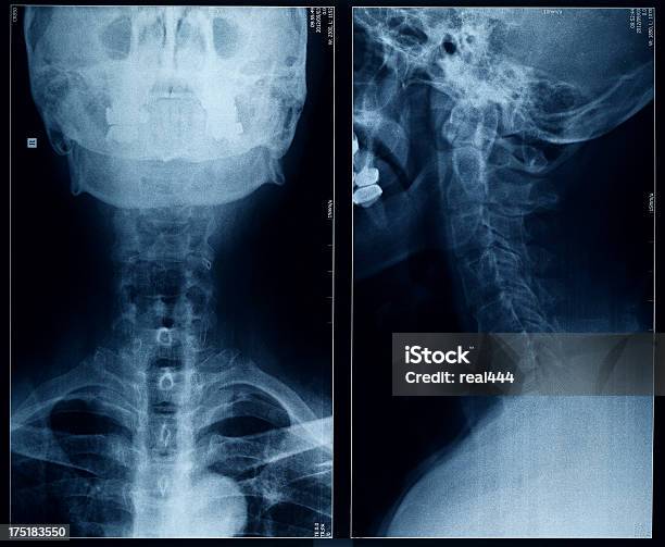 Xray Image Stock Photo - Download Image Now - Anatomy, Animal Bone, Animal Rib Cage