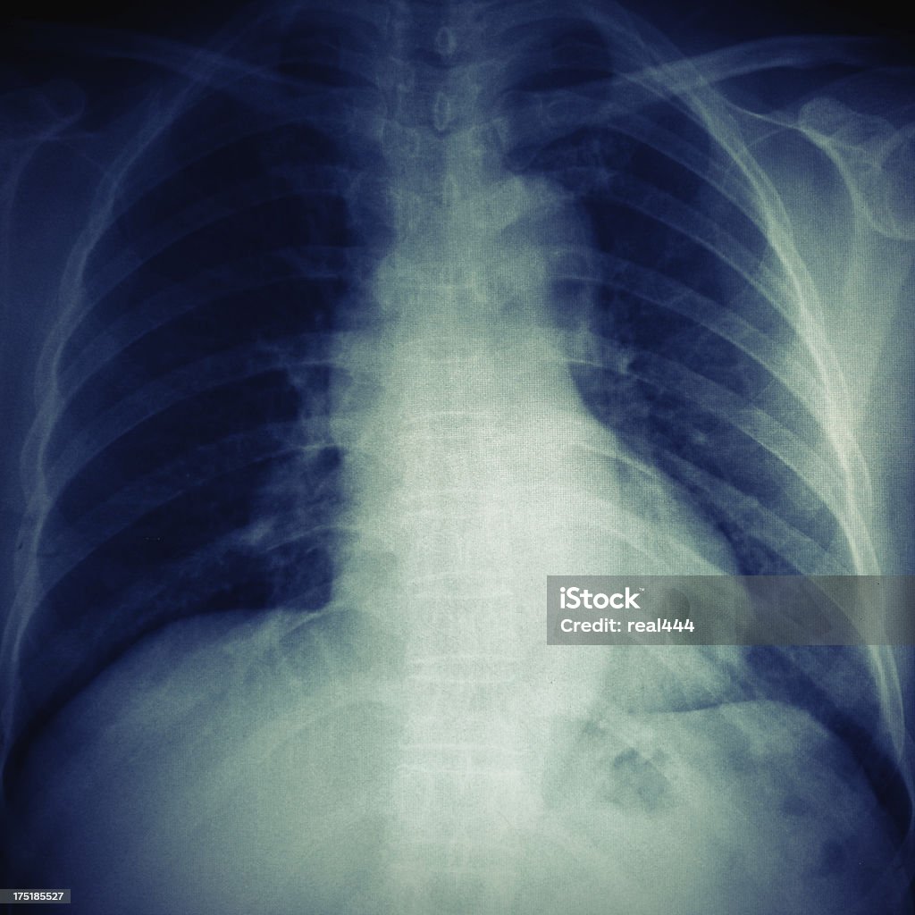 Una radiografía de tórax imagen - Foto de stock de Anatomía libre de derechos