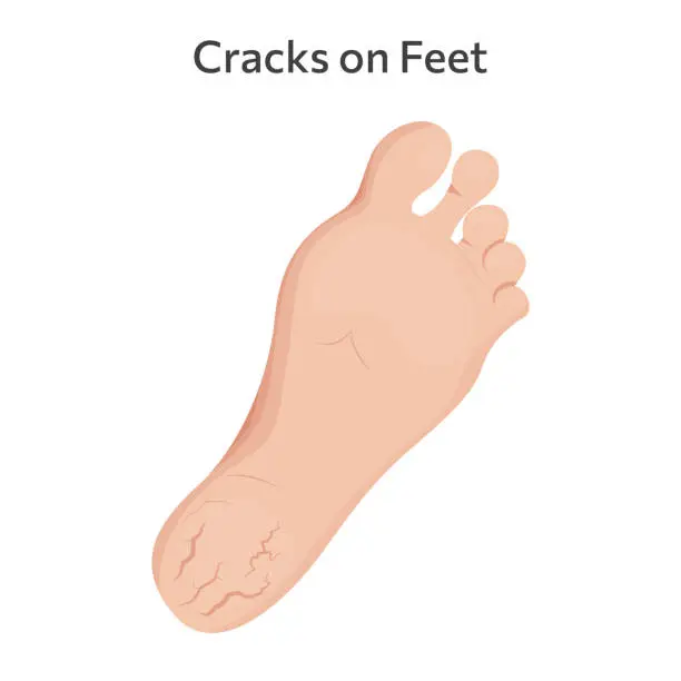 Vector illustration of Cracks on feet vector illustration design.