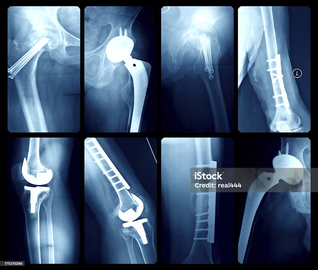 X-레이 일러스트 인공 관절 - 로열티 프리 고관절 치환술 스톡 사진