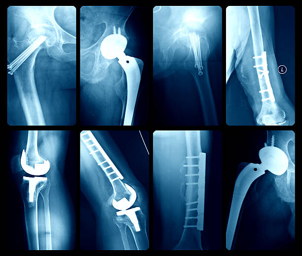 x-레이 일러스트 인공 관절 - hip replacement 뉴스 사진 이미지