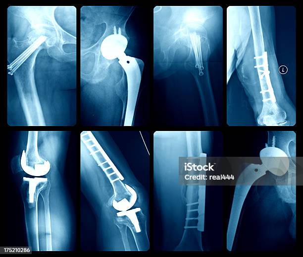 X레이 일러스트 인공 관절 고관절 치환술에 대한 스톡 사진 및 기타 이미지 - 고관절 치환술, 수술, 엉덩관절