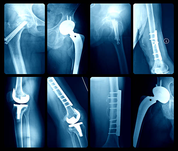 X-ray illustration of artificial joints X-ray Artificial joints artificial knee photos stock pictures, royalty-free photos & images