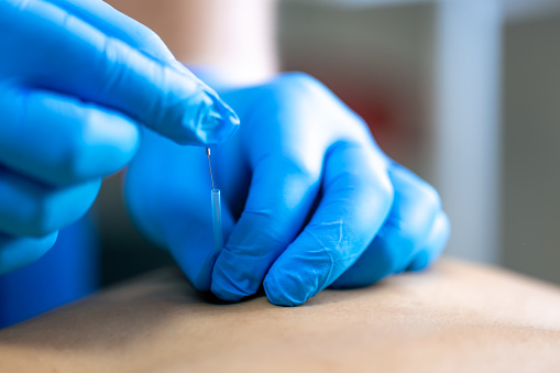Close up of a needle and hands of physiotherapist doing a dry needling in a physiotherapy center.