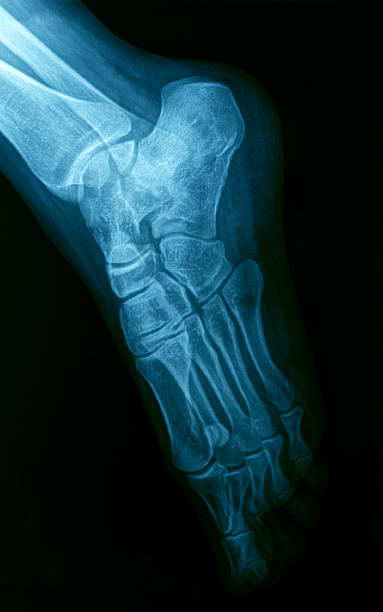 imagerie par rayons x des pieds. - bending human foot ankle x ray image photos et images de collection