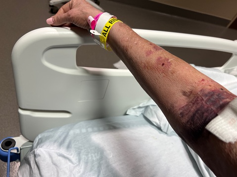Patient is bruised after 3 intravenous attempts made vein unusable. She is a hard to stick patient that needs a vein finder to help with IV insertion