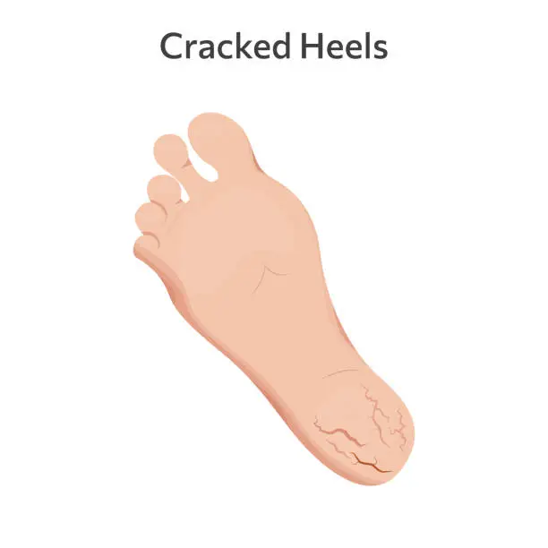 Vector illustration of Dry and rough skin on heel, slough and calluses.