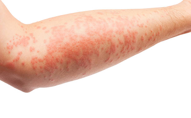 Eczema . Eczema symptom on human skin. red wasp stock pictures, royalty-free photos & images