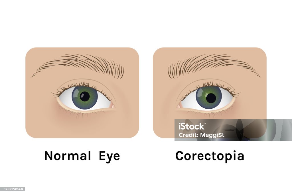 Normal Optoms Realistic Human Normal Eyes And With Corectopia Vector Illustration ...