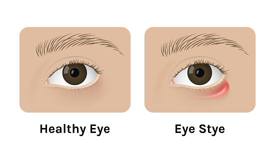 Realistic human healthy eye and with stye vector illustration design. Red inflammation, anatomy, health.
