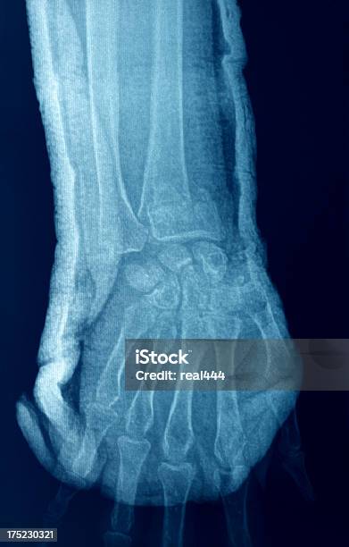 Hand Xray Stockfoto und mehr Bilder von Gelenkrheumatismus - Gelenkrheumatismus, Röntgenbild, Anatomie