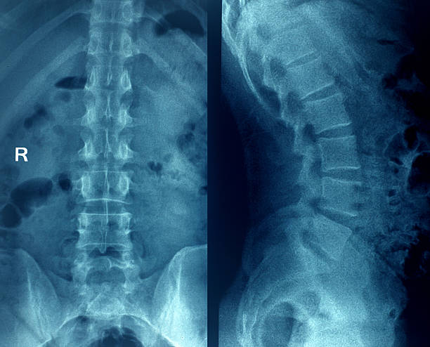 xray - pain rib cage x ray image chest imagens e fotografias de stock