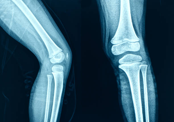 la radiografía de la rodilla de los huesos pierna humana anatomía - imagen de rayos x fotos fotografías e imágenes de stock