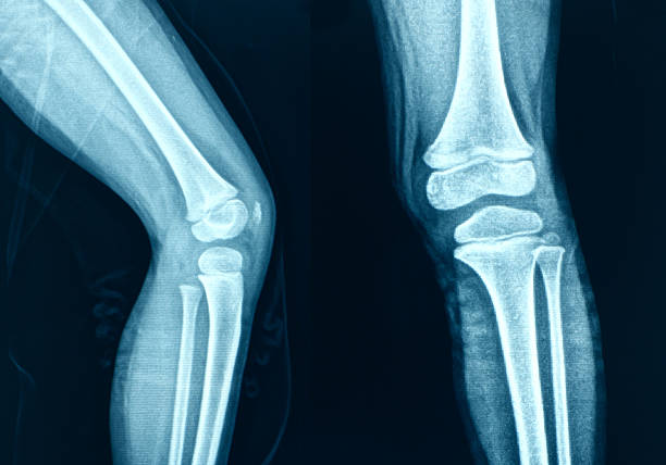 膝の部位の x 線骨人の脚 - cartilage patella human knee medical exam ストックフォトと画像