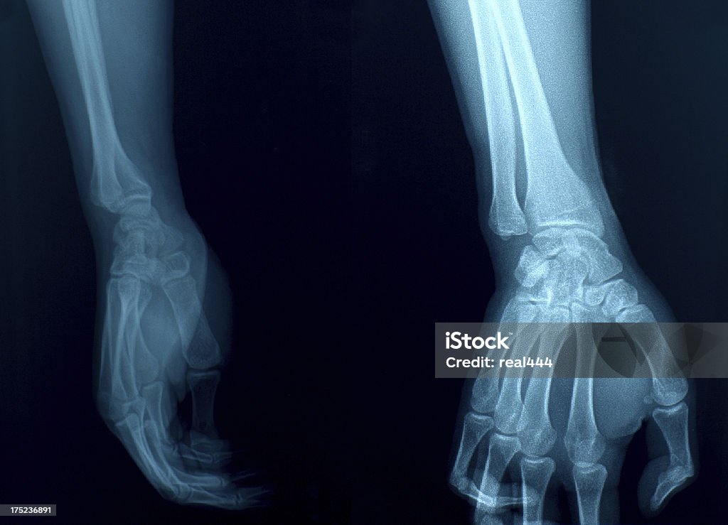 Zdjęcie rentgenowskie rąk - Zbiór zdjęć royalty-free (Reumatoidalne zapalenie stawów)