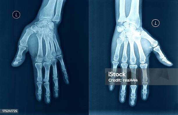 Xray Image Hände Stockfoto und mehr Bilder von Gelenkrheumatismus - Gelenkrheumatismus, Röntgenbild, Daumen