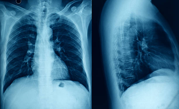 胸 x 線画像 - pain rib cage x ray image chest ストックフォトと画像