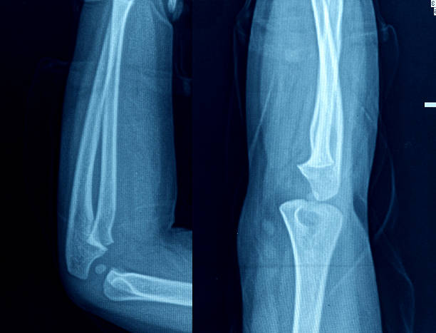 istock Knee X-Ray Bones Human Leg Anatomy 175267918
