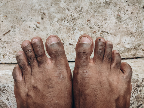 blackened toes due to exposure to heat and radiation, Asian feet, black feet, black skin color