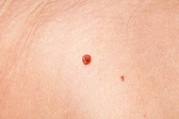 Skin Wart With A Hair Stock Photos, Pictures & Royalty-Free Images - iStock Skin Wart With A Hair Stock Photos, Pictures & Royalty-Free Images - iStock