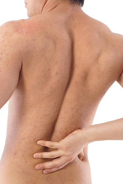통증 등근육 - acne back rear view men 뉴스 사진 이미지