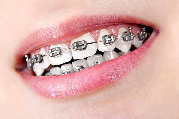 dentes com aparelho dentário - teenager body care adolescence human lips imagens e fotografias de stock