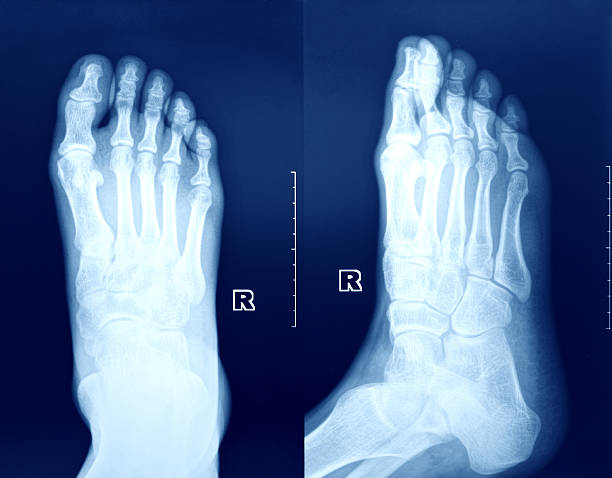imagerie par rayons x des pieds. - bending human foot ankle x ray image photos et images de collection
