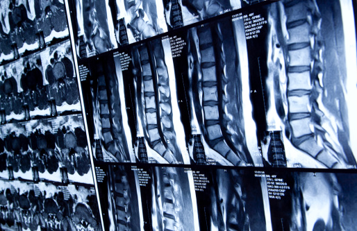 La MRI de la región lumbar de la columna vertebral humana photo