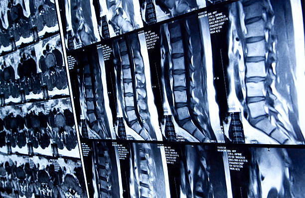 MRI scan of human lumbar spine