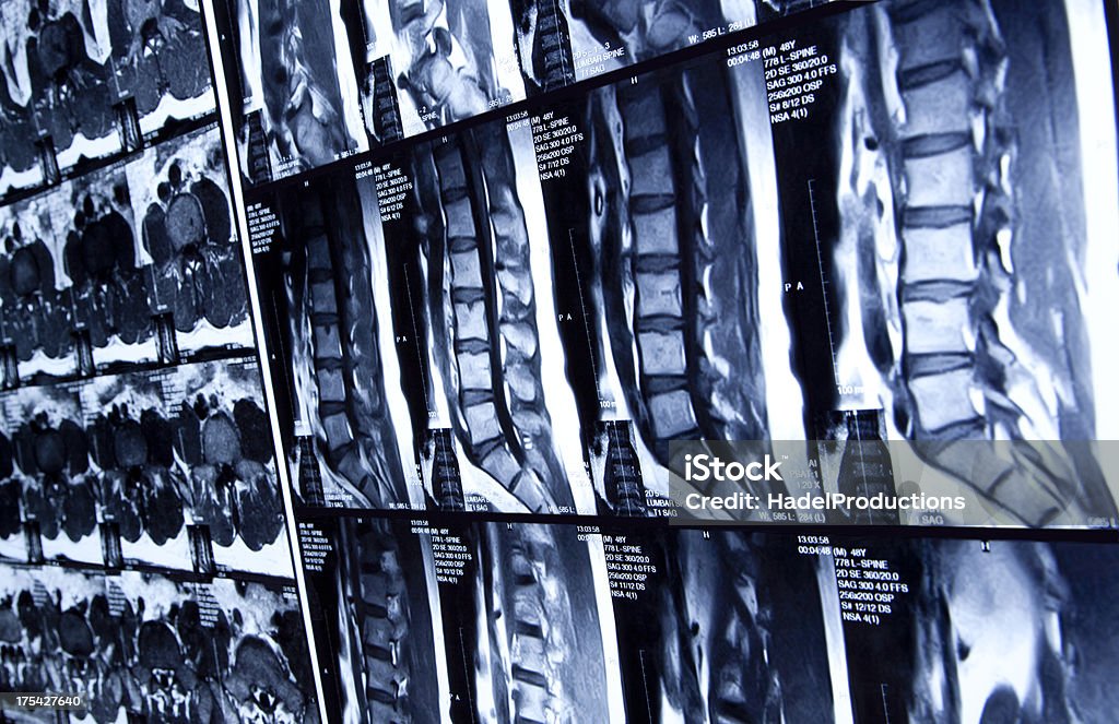 MRI scan of human lumbar spine X-ray Image Stock Photo