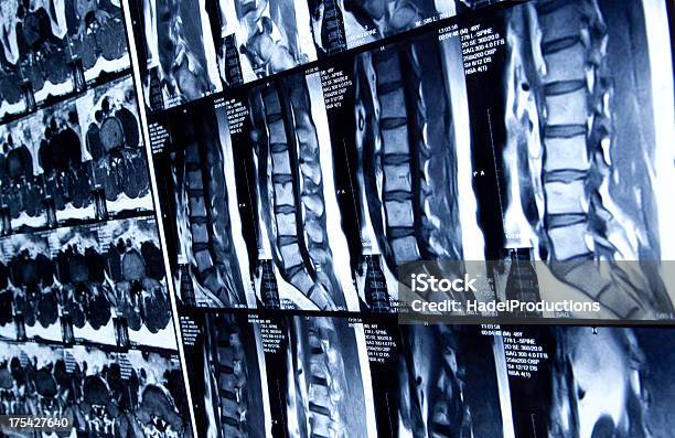 Mri Scan Of Human Lumbar Spine Stock Photo - Download Image Now - X-ray Image, MRI Scan, Medical X-ray